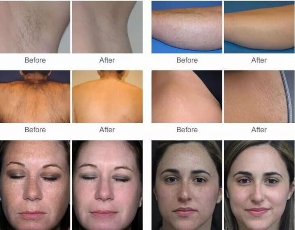 IPL Epilation permanente indolore OPT SHR – Image 2
